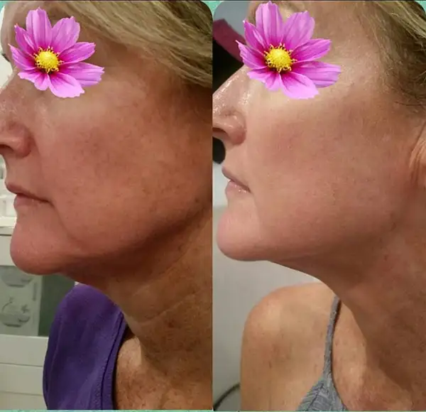 Before and After Treatment side-by-side